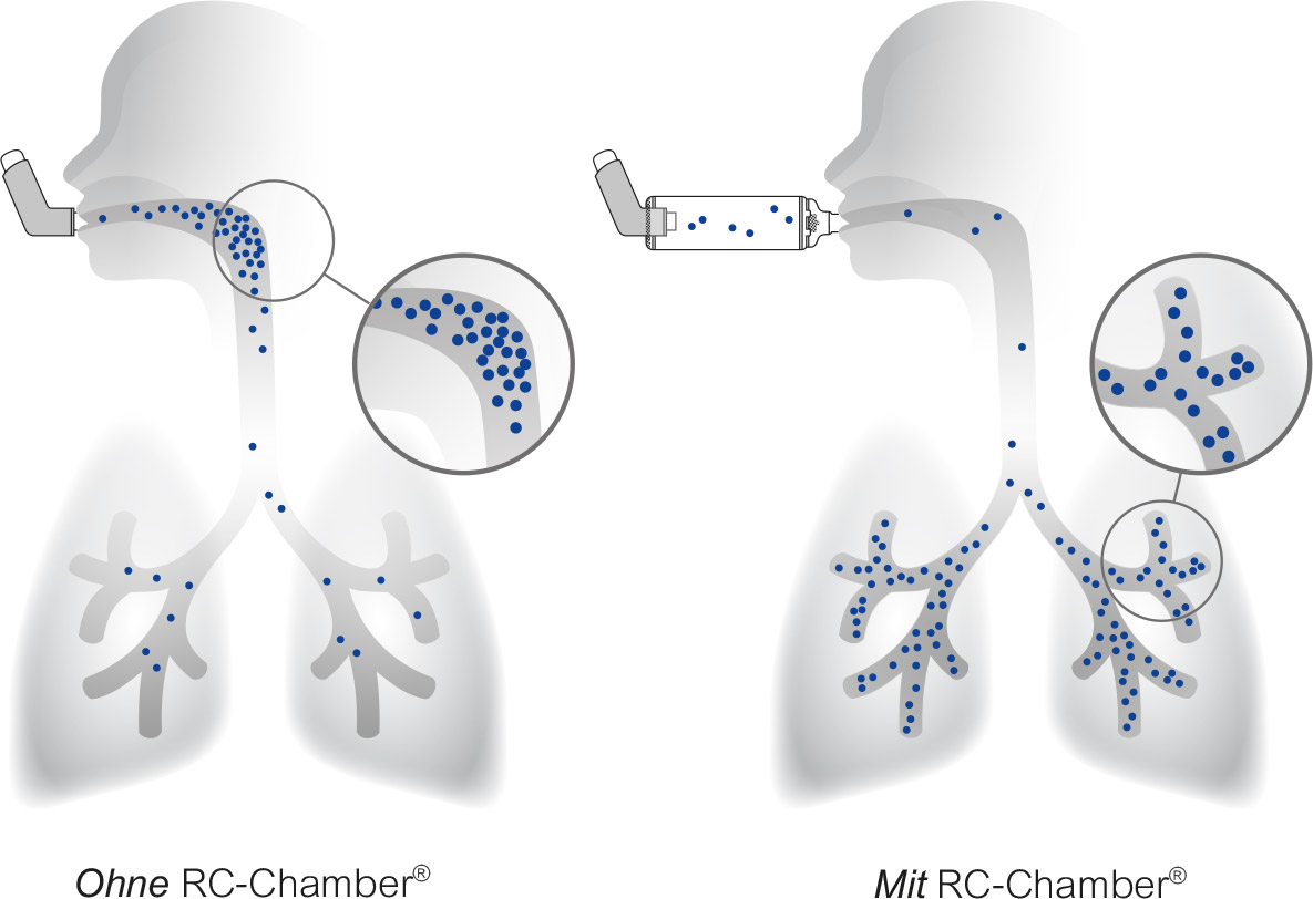 Wirkung der RC-Chamber Inhalierhilfe und Funktionsprinzip